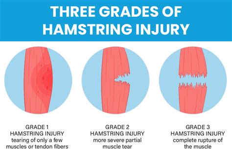 what test shows muscle tears|grade 1 muscle strain vs tear.